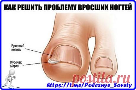 Как правильно решить проблему вросших ногтей и что такое ногтоеда? 

Ногтоеда — это достаточно болезненное и причиняющее сильный дискомфорт состояние, при котором кожа вокруг ногтя воспаляется (может быть из-за врастания ногтя), а в некоторых случаях и сопровождается наличием инфекции.
Показать полностью…