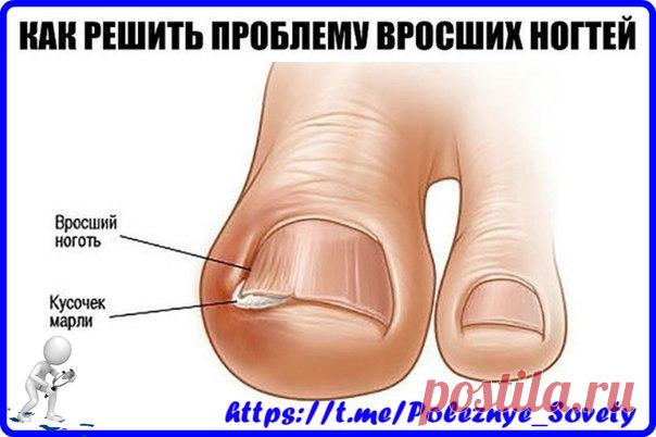 Как правильно решить проблему вросших ногтей и что такое ногтоеда? 

Ногтоеда — это достаточно болезненное и причиняющее сильный дискомфорт состояние, при котором кожа вокруг ногтя воспаляется (может быть из-за врастания ногтя), а в некоторых случаях и сопровождается наличием инфекции.
Показать полностью…