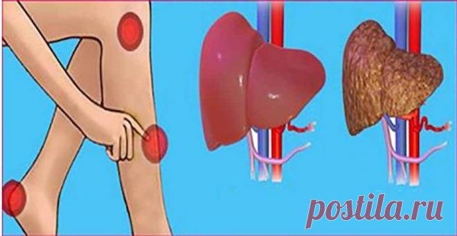 10 предупреждающих знаков того, что ваша печень не функционирует должным образом Осторожно! Эти токсины накапливаются в ваших жировых тканях!



Следите за своим здоровьем!







 


Наша печень является одним из самых важных органов нашего организма. Это самый тяжелый и второй п…