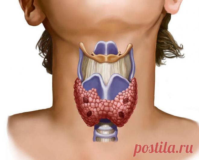 Досвідчений лікар: йод - потужна зброя проти вірусних інфекцій | ОТОЖ