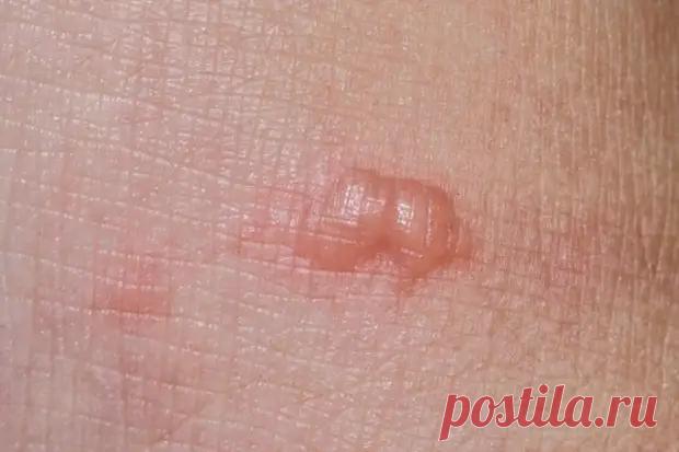 Чем опасна обычная кошка: 3 болезни от простых царапин и укусов - ПолонСил.ру - социальная сеть здоровья - Медиаплатформа МирТесен