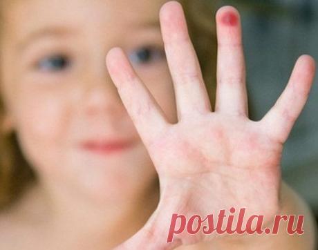 Как удалять бородавки у детей? В детстве многие верили в миф, что бородавки вырастают, если подержать в руках лягушку. Но и в более взрослом возрасте их появление вызывает вопросы.