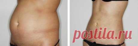 Каждое утро натощак я пила аптечное средство, поэтому избавилась от висячего жира и дряблой кожи на животе за 12 дней | Решила похудеть | Яндекс Дзен