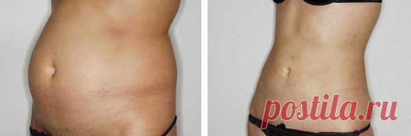 Каждое утро натощак я пила аптечное средство, поэтому избавилась от висячего жира и дряблой кожи на животе за 12 дней | Решила похудеть | Яндекс Дзен