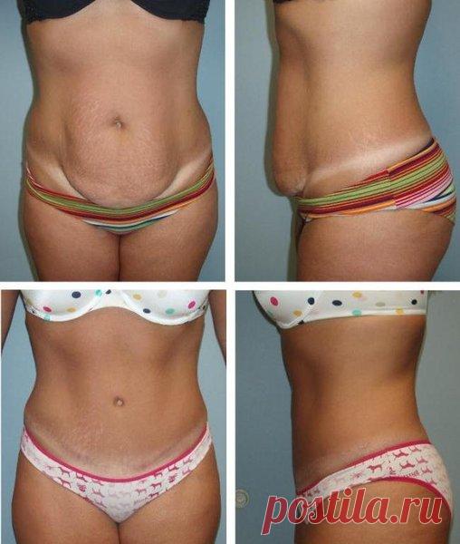 Мне 52 года – «Дряблая и обвисшая кожа» на шее, руках, бёдрах и животе для меня уже не проблема | Ver-A | Яндекс Дзен