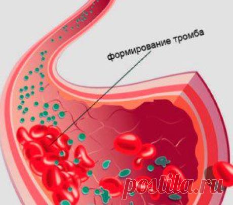 Разжижение крови народными средствами