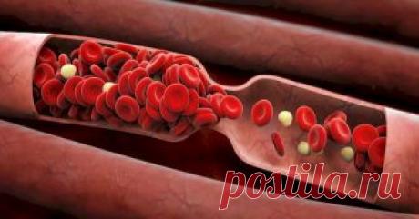 6 признаков, что вашей жизни угрожает опасный тромб Тромб не будет ждать скорую помощь!