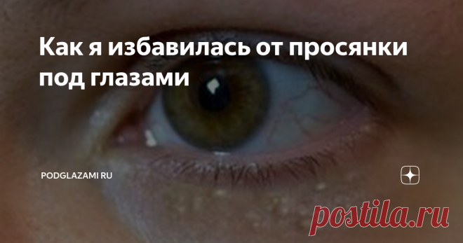 Как я избавилась от просянки под глазами В подростковом возрасте у меня начались проблемы с кожей лица, она была довольно жирная и периодически покрывалась мелкими воспалениями. Я всегда следила за собой, использовала качественные скрабы, кремы и маски, боролась всеми возможными средствами.