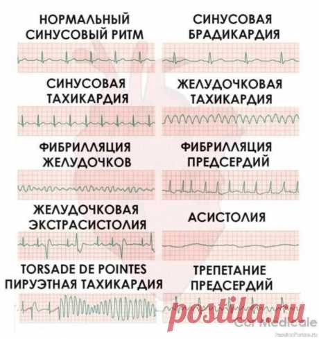 Наше здоровье. Что означает электрокардиограмма .