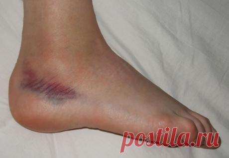 Голеностопный сустав — это несущий шарнир, где встречаются три кости: большеберцовая и малоберцовая кость голени и таранной кости стопы, которая располагается поверх пяточной кости. Связки, сильные соединения фиброзной ткани, способные лишь на небольшое растяжение, удерживающие кости вместе. Сухожилия прикрепляют мышцы к костям, чтобы двигать голеностопный сустав, они более мягкие и более эластичные. Любая из этих структур — кости, связки и сухожилия — могут быть травмированы, и в этой статье об