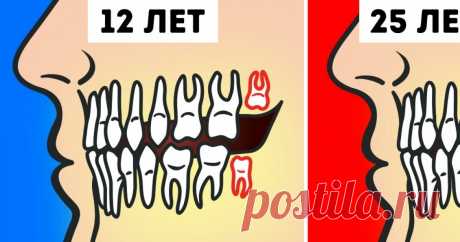 Нужно ли на самом деле удалять зубы мудрости? Зубы мудрости — 8-е зубы в ряду или, проще говоря, «восьмерки», которые уже давно не нужны человеку для нормального пережевывания пищи. Они начинают прорезаться в возрасте от 12 до 25 лет, и как раз в этот период многим рекомендуют их удалить. Но так ли это необходимо? AdMe.ru проанализировал разные мнения по этому вопросу. И вот что нужно знать, чтобы принять верное решение.