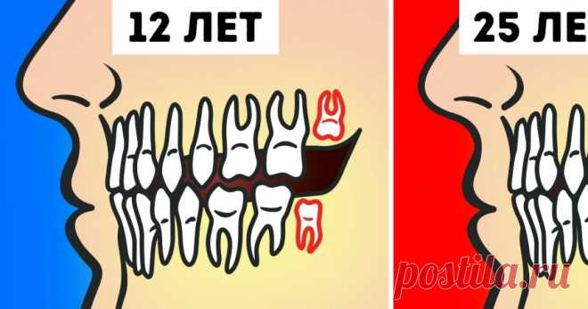 Нужно ли на самом деле удалять зубы мудрости? Наконец-то все толково объяснили.