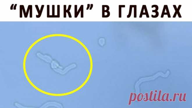 Откуда берутся «мушки» перед глазами? | Краше Всех