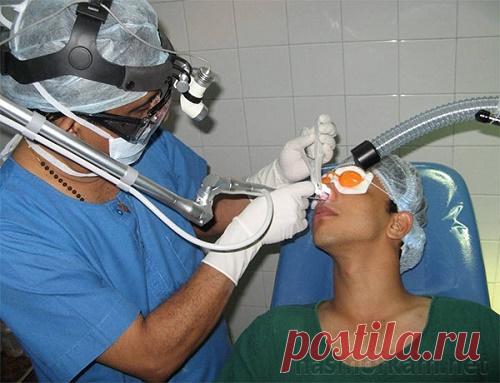 Искривление носовой перегородки: лечение без операции и лазером