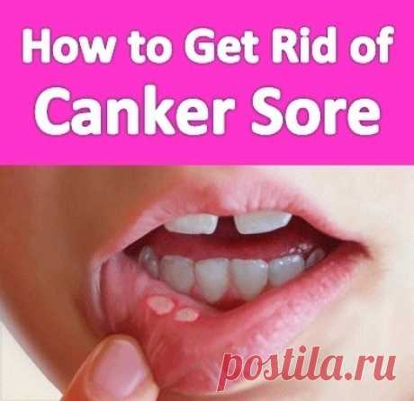 How to Get Rid of Canker Sores Fast | Virtual Clinic