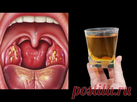 УБИВАЕТ боль в горле и воспаление за 1 день! 2 простых и очень эффективных рецепта!
