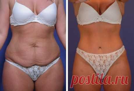 Благодаря народному средству и двум упражнениям в свои 50: Я убрала жирный живот за 15 процедур! | Худеем Дома | Яндекс Дзен