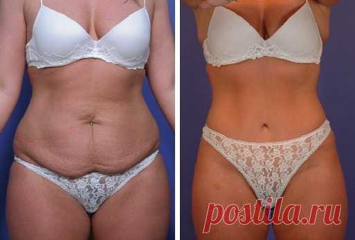 Благодаря домашнему средству: Я убрала висячий живот за 4 недели использования. Также я похудела на 6 кг. | Подслушано у диетолога | Яндекс Дзен