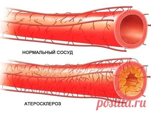 Как очистить артерии за месяц. Народное средство