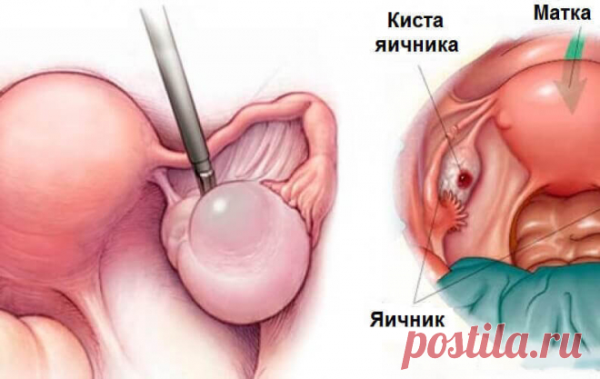 Кисты яичника: 9 тревожных сигналов