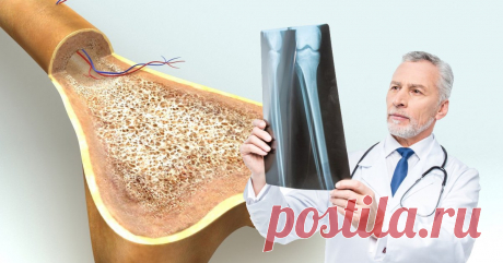 7 продуктов для костей. Забудь про травмы и переломы! Долгое время считалось, что основным источником для укрепления костной ткани является кальций, поэтому многие из нас в детстве даже грызли мел, чтобы зубы, ногти и кости были крепкими. Но оказалось, что одного кальция недостаточно. Кроме этого элемента, для укрепления и роста костей тебе просто необходимы фосфор, магний, цинк, медь, витамины и минеральные вещества, белки, жирные кислоты. Только в связке они