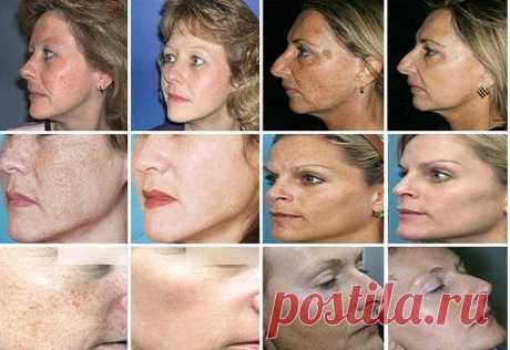 Пигментация. Причины и лечение