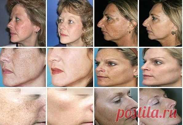 Пигментация. Причины и лечение