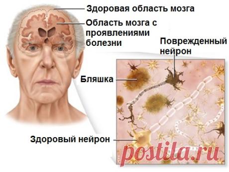 Профилактика болезни Альцгеймера: 5 рекомендаций - Шаг к Здоровью