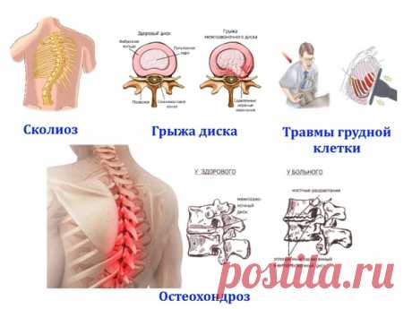 Почему болит в спине и отдает в грудь или живот?
Основные причины: