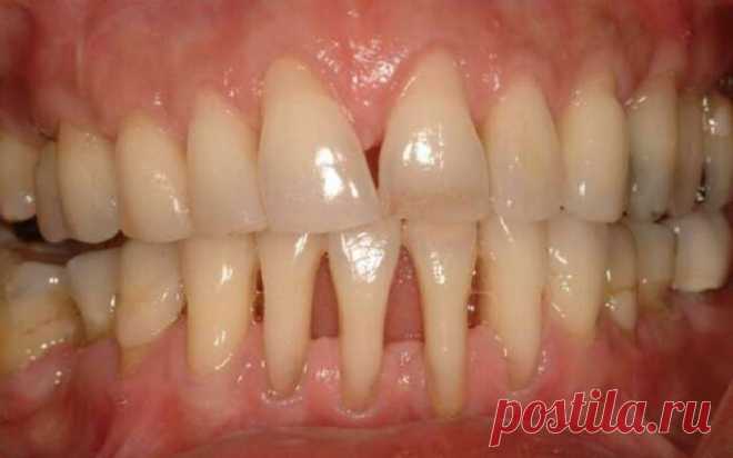 Оголилась шейка зуба? Узнай, как вернуть десну обратно! — Домашний уют