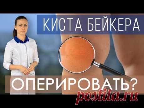 Киста Бейкера. Как лечить кисту Бейкера коленного сустава? Всегда ли нужно оперировать? Упражнения.