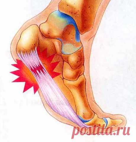Симптомы пяточной шпоры | в закладки
Симптомы пяточной шпоры известны 60%-ам пожилого населения планеты: острые боли при нагрузке на пятку и отек стопы, не позволяющий одеть обувь.

Боли в пятке при движении возникают не из-за самого костного разрастания (остеофита), который рентгенолог очень четко определяет на снимке при наличии заболевания, а плантарного фасциита (воспаления подошвенной связки). Они бывают двух типов: «стартовые» и динамические (возникающие при физической нагрузке).