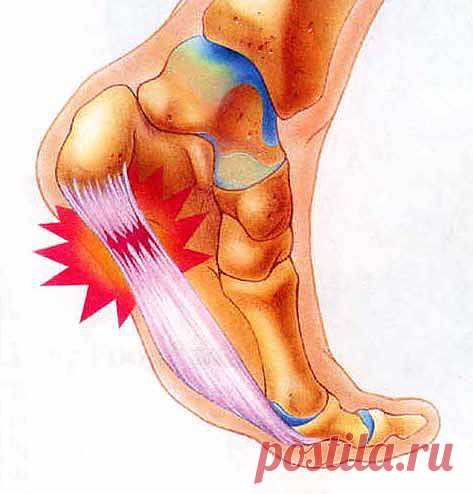 Симптомы пяточной шпоры | в закладки
Симптомы пяточной шпоры известны 60%-ам пожилого населения планеты: острые боли при нагрузке на пятку и отек стопы, не позволяющий одеть обувь.

Боли в пятке при движении возникают не из-за самого костного разрастания (остеофита), который рентгенолог очень четко определяет на снимке при наличии заболевания, а плантарного фасциита (воспаления подошвенной связки). Они бывают двух типов: «стартовые» и динамические (возникающие при физической нагрузке).