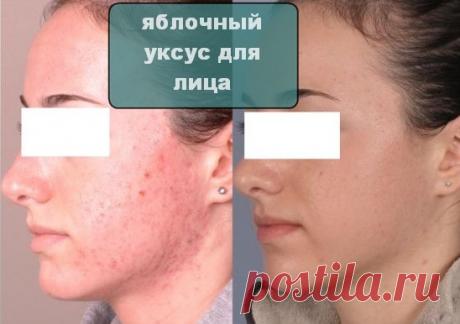 Яблочный уксус очень полезен для лица. Почему? Как применять? - CELEBNIK. RU Косметология не стоит на месте и ежедневно предлагает новые средства для ухода...