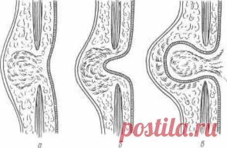 Жировик (липома). Лечение жировика народными средствами