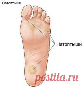Как избавится от мозолей? | Блог сайта Muza.Name