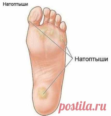 Как избавится от мозолей? | Блог сайта Muza.Name