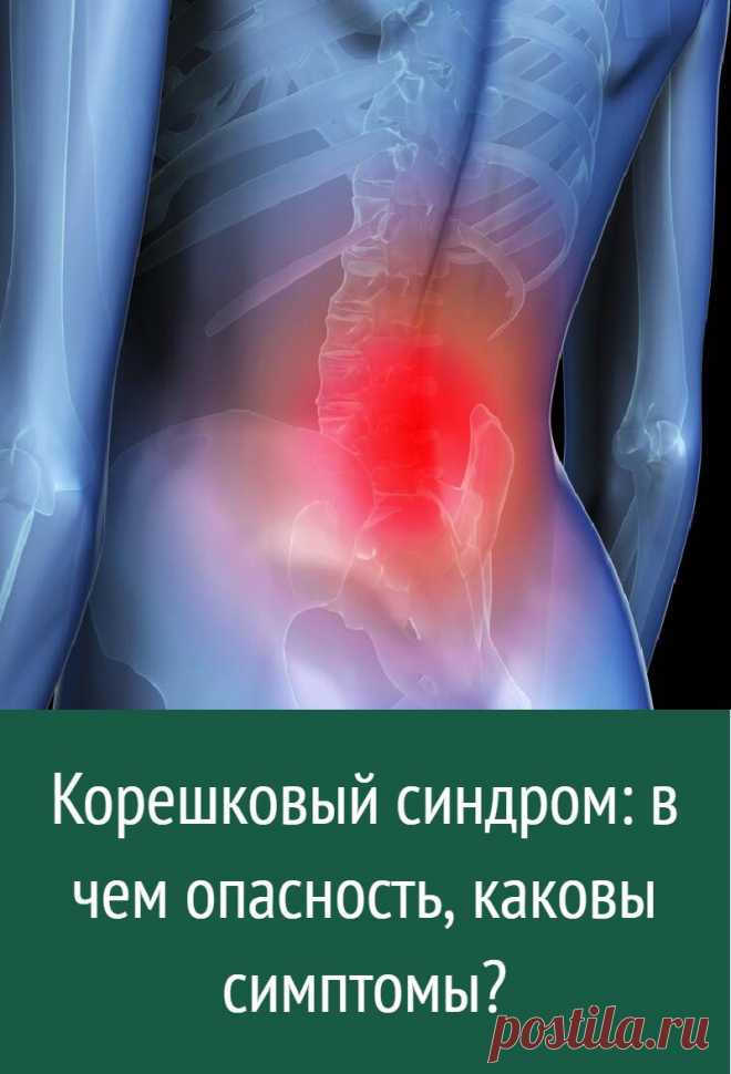 Корешковый синдром: в чем опасность, каковы симптомы?
