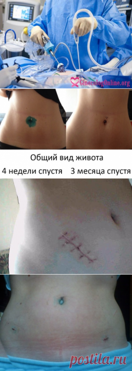 Лапароскопия яичника, труб, удаление кисты - отзывы и цены в Москве