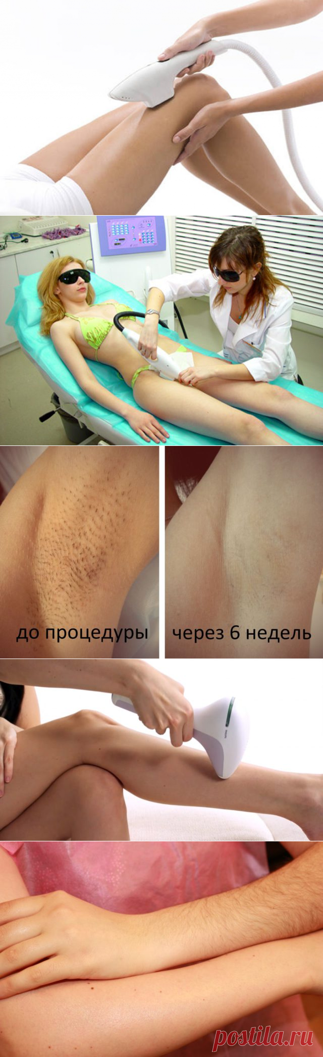 Фотоэпиляция: отзывы, фото до и после