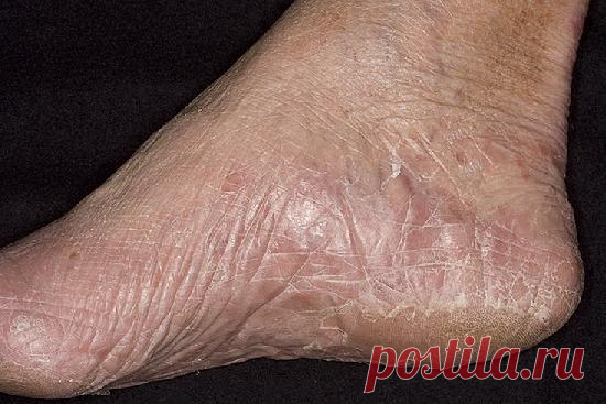 Как избавиться от грибковых заболеваний с помощью народной медицины