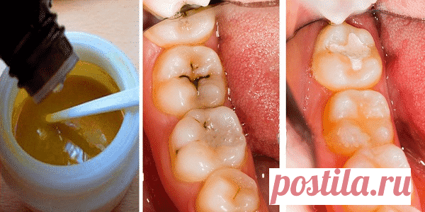Эта маска для зубов оставит стоматологов без работы! Всего 4 компонента… 🌶 Кликните, чтобы открыть или оставить комментарий👆