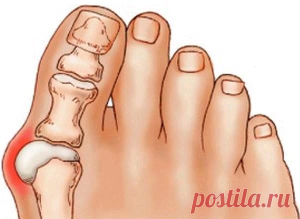 ШИШКУ НА НОГЕ УБИРАЕМ КОПЕЕЧНЫМИ СПОСОБОМ!

Помню, как однажды на уроке биологии почувствовала себя по-настоящему ужасно. Мы изучали что-то связанное с генетикой, и учительница рассказывала нам о том, какие генетические заболевания передаются по наследству.

В качестве яркого примера она привела косточку на ноге. Увеличенная косточка, некрасивая и болезненная, как подробно расписывала преподавательница, передается по наследству по женской линии. Если у вашей мамы или бабуш...