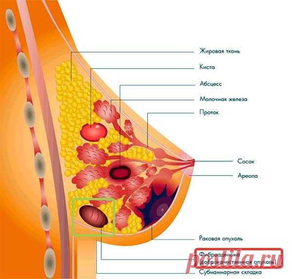 Фиброма молочной железы: симптомы, эффективное лечение
