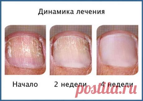 ГРИБОК_СГИНУЛ навсегда! Этот домашний_продукт, который навсегда избавит вас_от грибка….