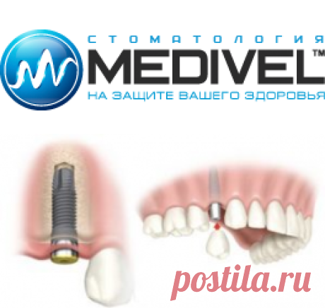 Протезирование зубов на имплантах в медицинском центре "Medivel" | MEDIVEL