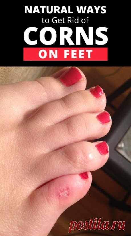 Natural Ways to Get Rid of Foot Corns