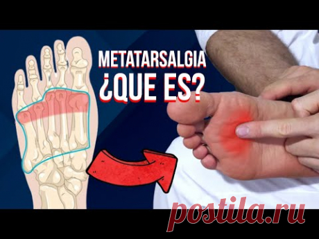 🦶🏻 Que es la METATARSALGIA, causas, sintomas y tratamiento