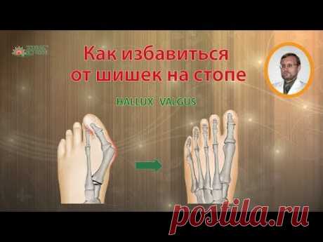 Как избавиться от косточки или шишки на большом пальце стопы / Hallux Valgus