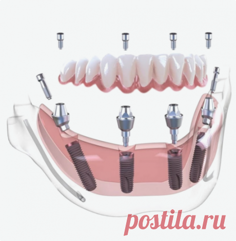 Имплантация зубов ALL-ON-4 (все на 4) в Краснодаре 🦷